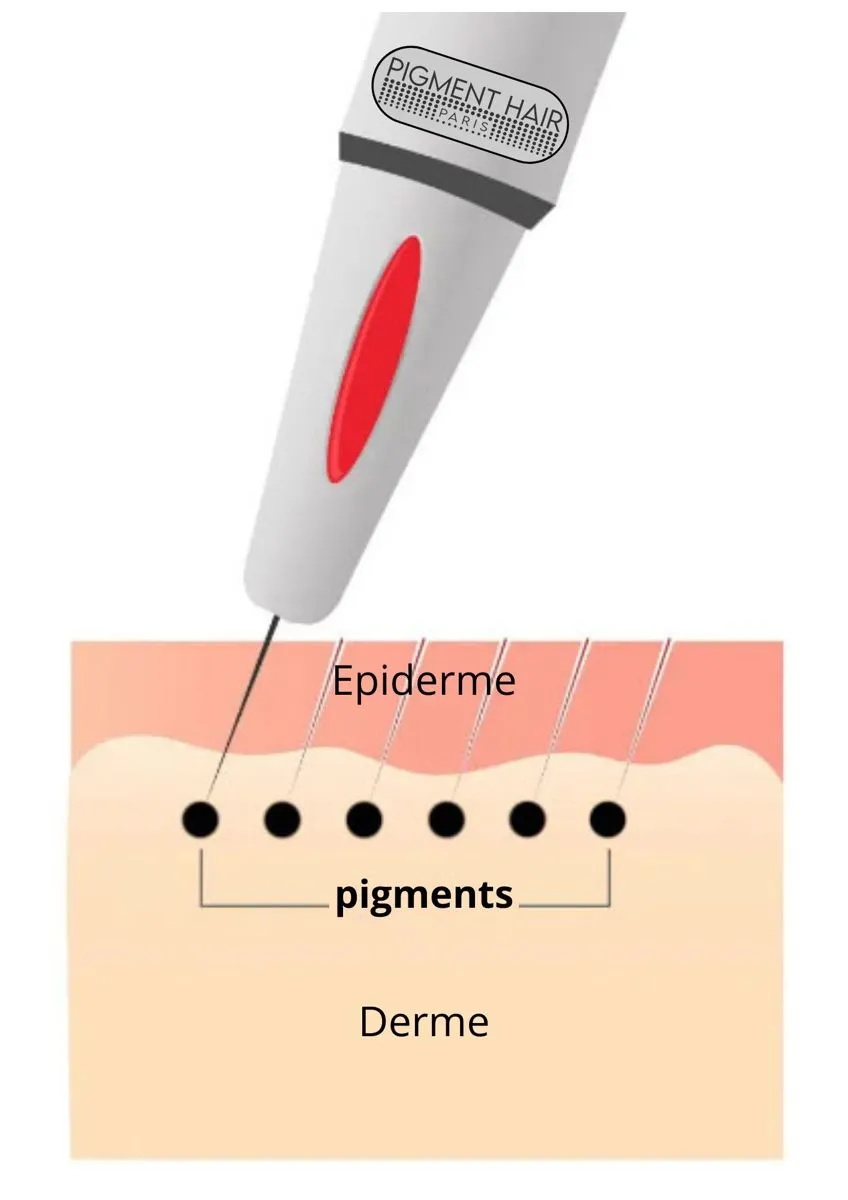 Qu'est-ce que la tricopigmentation ?