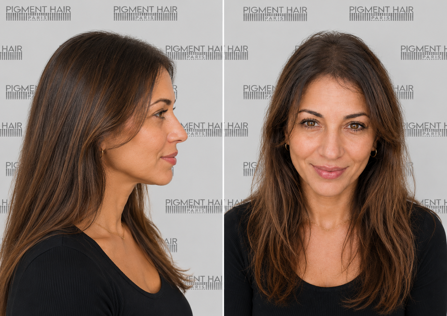 Découvrez Murielle 4 ans après sa tricopigmentation